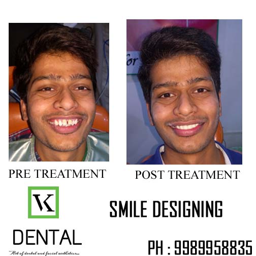 SMILE DESIGNING